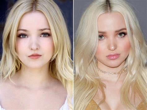 dove cameron before plastic sergury|Dove Cameron, Before and After .